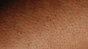 Primer plano de piel con manchas y pigmentación facial en mujer
