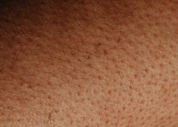 Primer plano de piel con manchas y pigmentación facial en mujer
